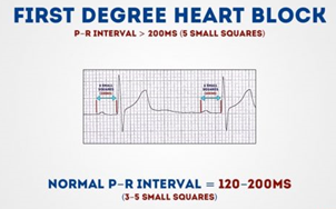 First degree heart block