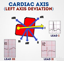 left axis deviation