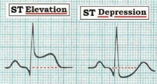 st elevation and depression